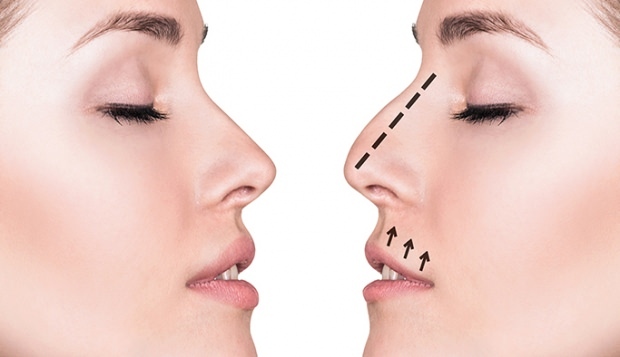 Bagaimana operasi hidung dilakukan? Dalam kasus apa operasi pembedahan hidung dilakukan?