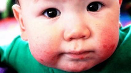 Bagaimana sariawan pada bayi? Apa yang baik untuk luka mulut pada bayi dan anak-anak?
