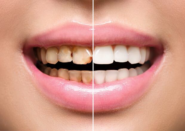 Sebagai akibat dari nutrisi yang tidak sehat, terjadi perubahan warna gigi dan kehilangan gigi