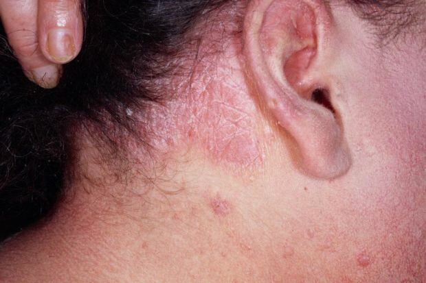 Apa saja gejala dermatitis seboroik dan siapa yang muncul? Makanan yang memicu penyakit