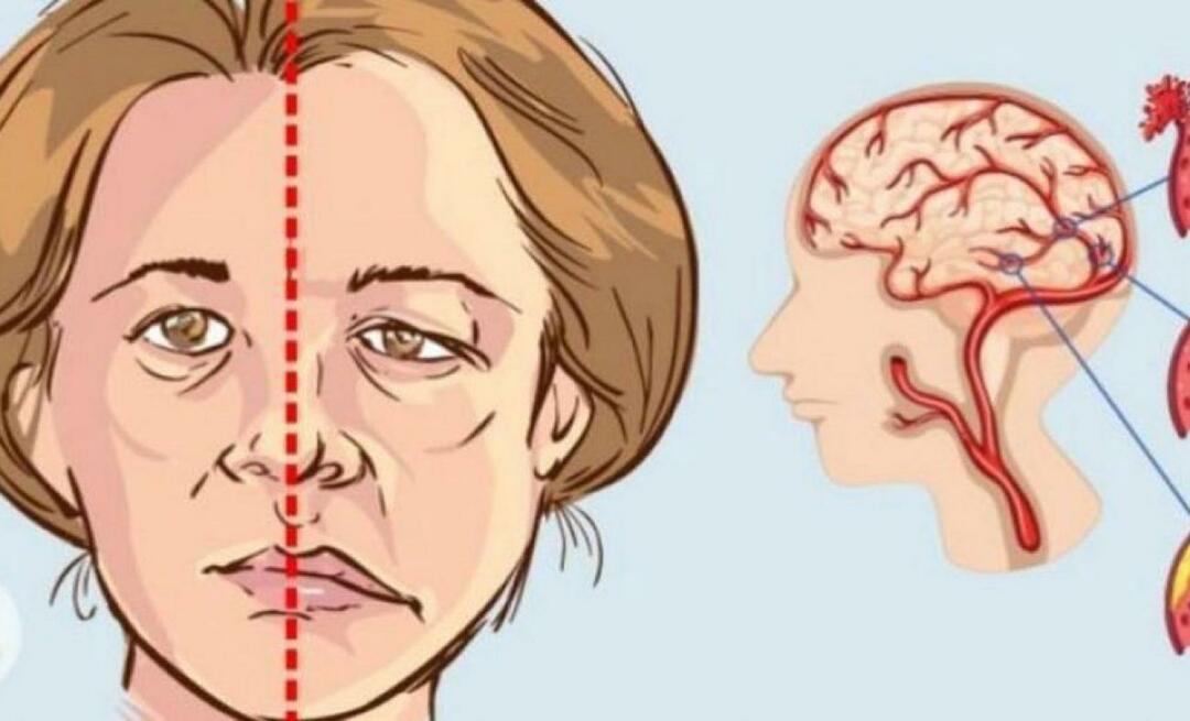 Apa itu stroke? Apa saja gejala stroke? Bagaimana cara mencegah stroke?