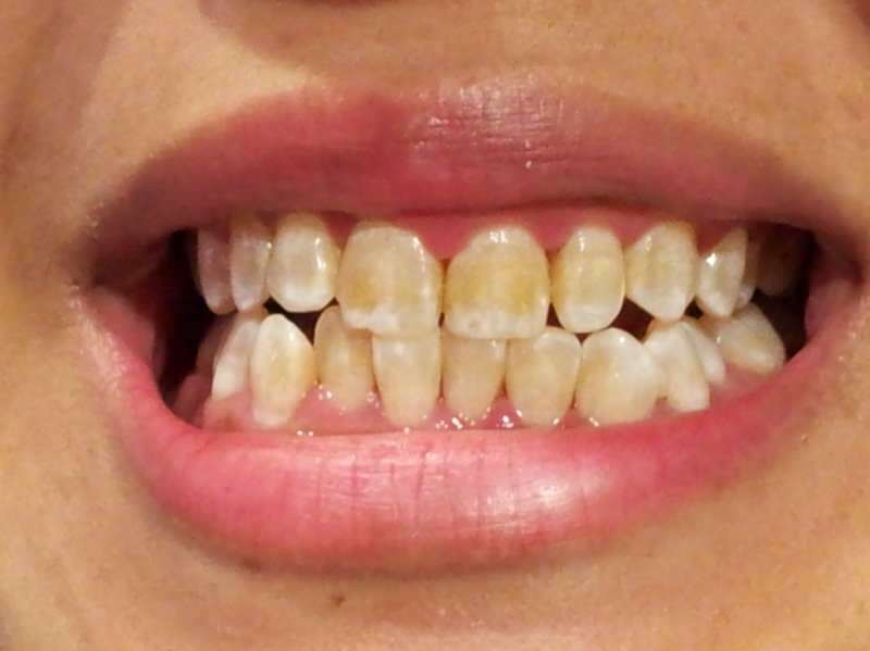 Mengapa bagian bawah gigi menjadi gelap? Memutihkan gigi Anda dalam seminggu dengan campuran ini!
