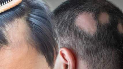 Apa itu Kurap (Alopecia areata)? Apa saja gejala kurap? Solusi efektif untuk kurap