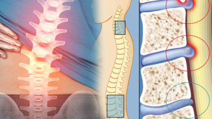 Apa itu penyempitan sumsum tulang belakang? Apa saja gejala penyempitan sumsum tulang belakang? Apakah ada obat untuk penyempitan sumsum tulang belakang?