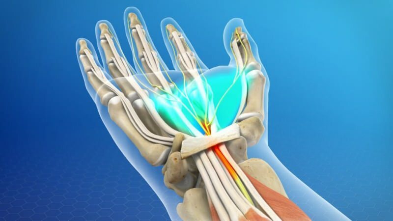 akibat tekanan, sistem otot pergelangan tangan rusak, yang menyebabkan sindrom carpal tunnel