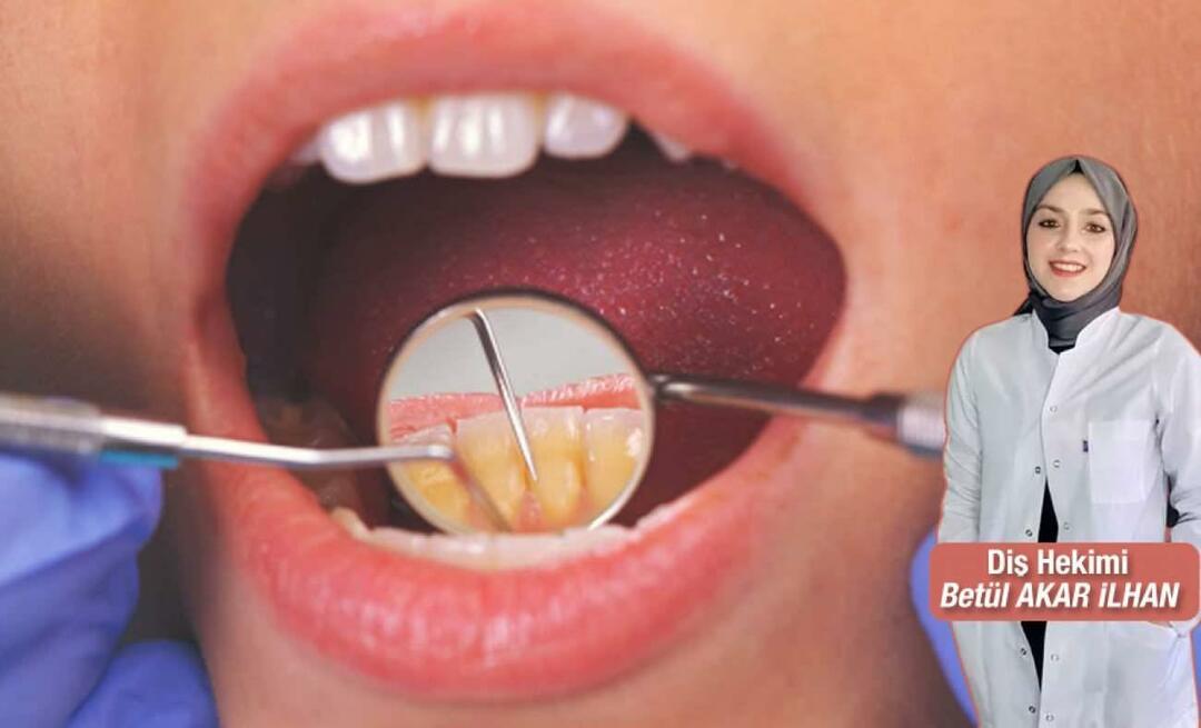 Apa yang harus dilakukan untuk menghindari karang gigi? Apa manfaat scaling gigi?