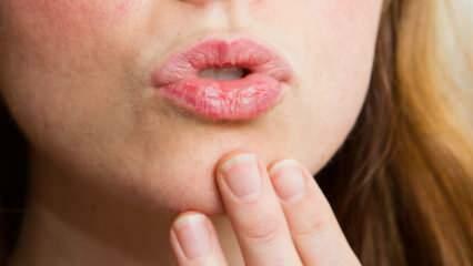 Bagaimana cara merawat bibir di rumah? Perawatan bibir kering yang mudah dalam 4 langkah