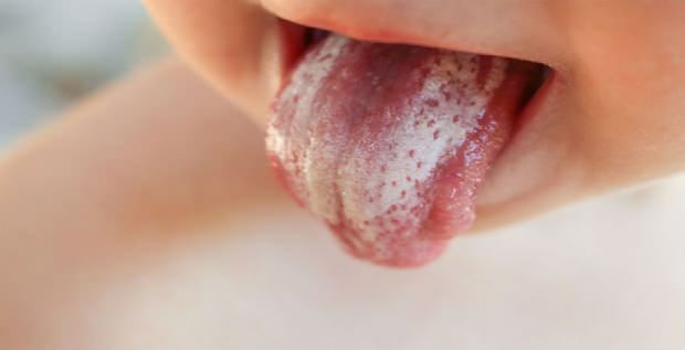 Perawatan jamur oral pada bayi