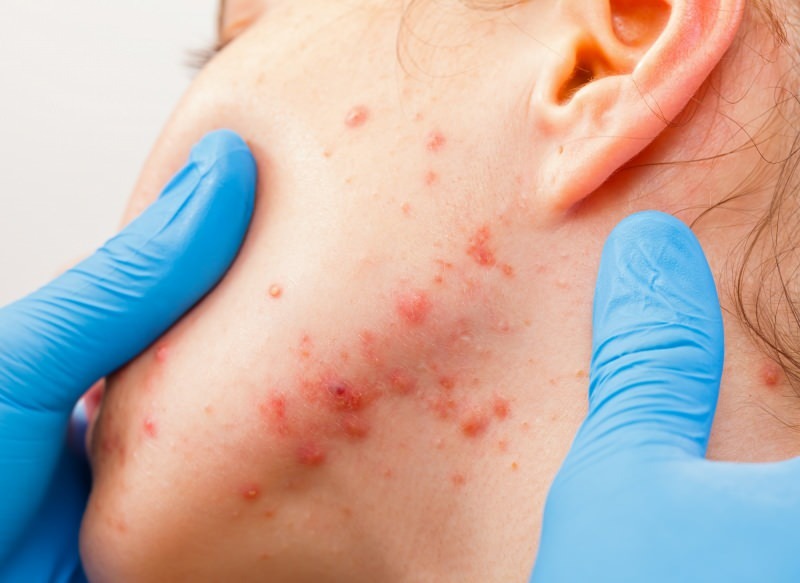 virus menyebabkan lecet pada permukaan kulit