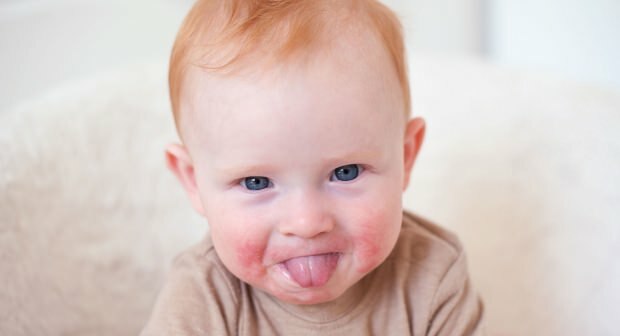 Perhatian pada bayi dengan pipi merah! Sindrom pipi menampar dan gejalanya