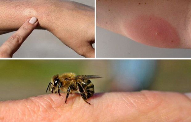 gejala alergi lebah