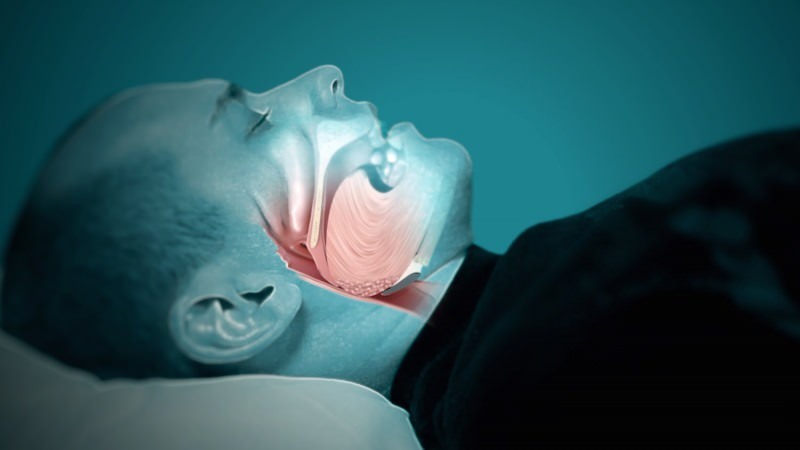 sleep apnea terjadi setelah mendengkur