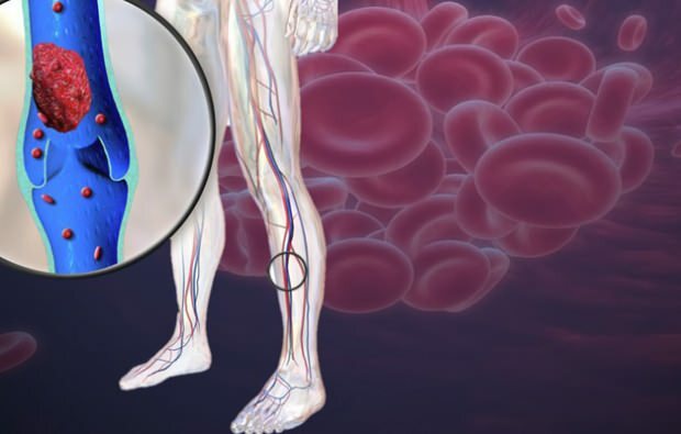 menurunnya sirkulasi darah di vena kaki menyebabkan rasa sakit